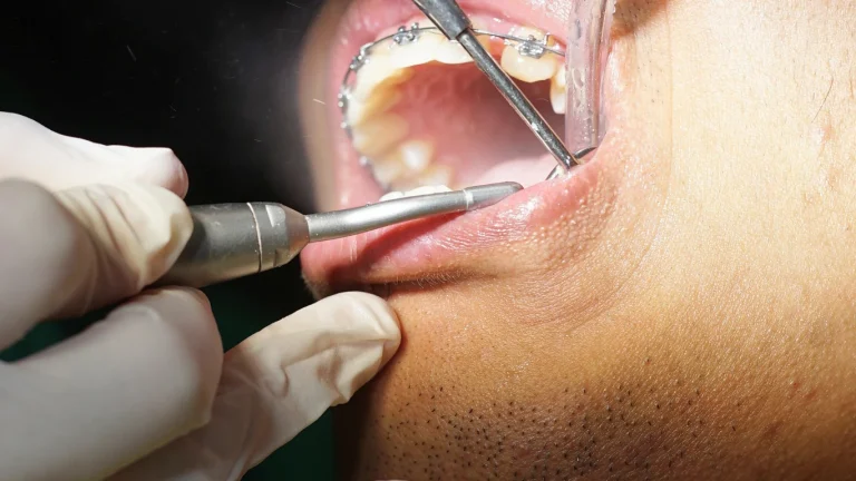 Perawatan behel gigi oleh dokter ortodonti di klinik gigi Cempaka Putih Estetika Dental Clinic"